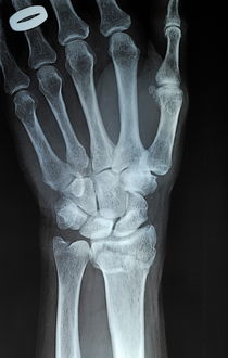 X-ray imagery of a hand with wedding ring by Sami Sarkis Photography