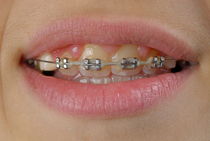 Orthodontic braces on teeth by Sami Sarkis Photography