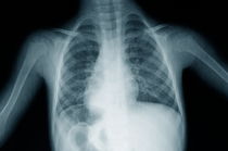 X-ray image of young boy's (12-13) torso von Sami Sarkis Photography